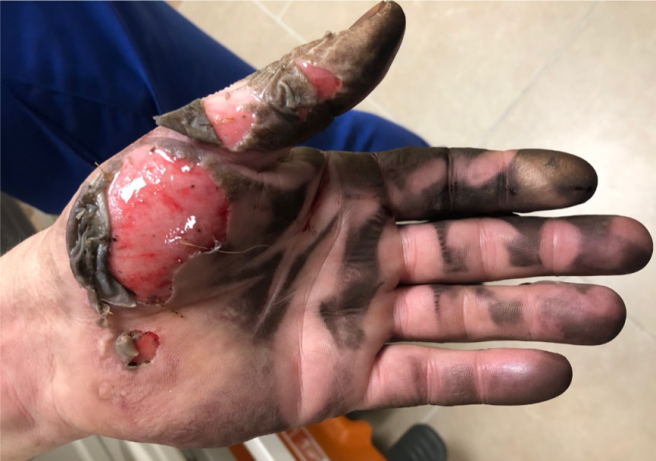 burns-from-low-voltage-electrical-injury