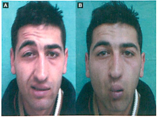 facial-nerve-paralysis-and-deafness-from-low-voltage-electrocution Facial paralysis from electrocution