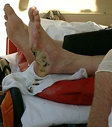 foot-injury-from-low-voltage-electrocution Foot injury from electrocution