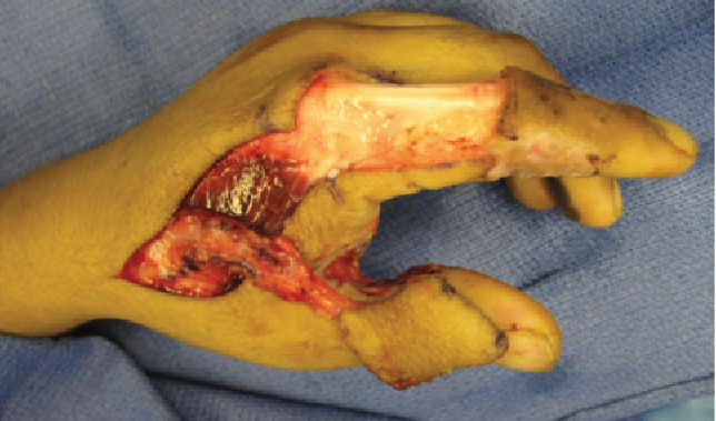 hand-reconstruction-after-low-voltage-electrocution Hand Injury After Low Voltage Electrocution