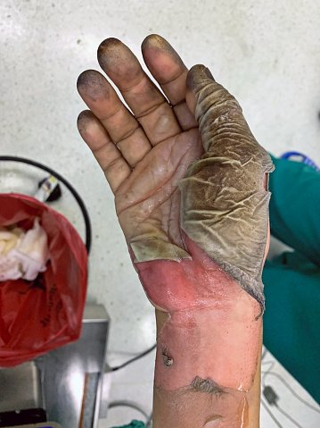 fresh electrical burn wound on hand, peeling skin Low voltage electrocution hand injury