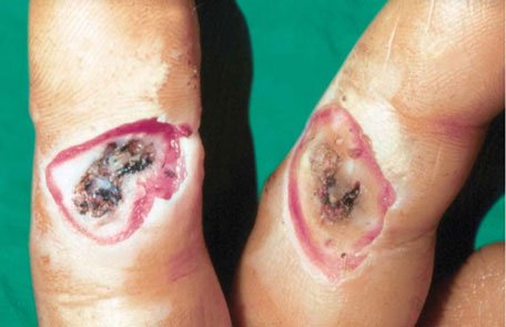 low-voltage-finger-burn Low voltage finger injury