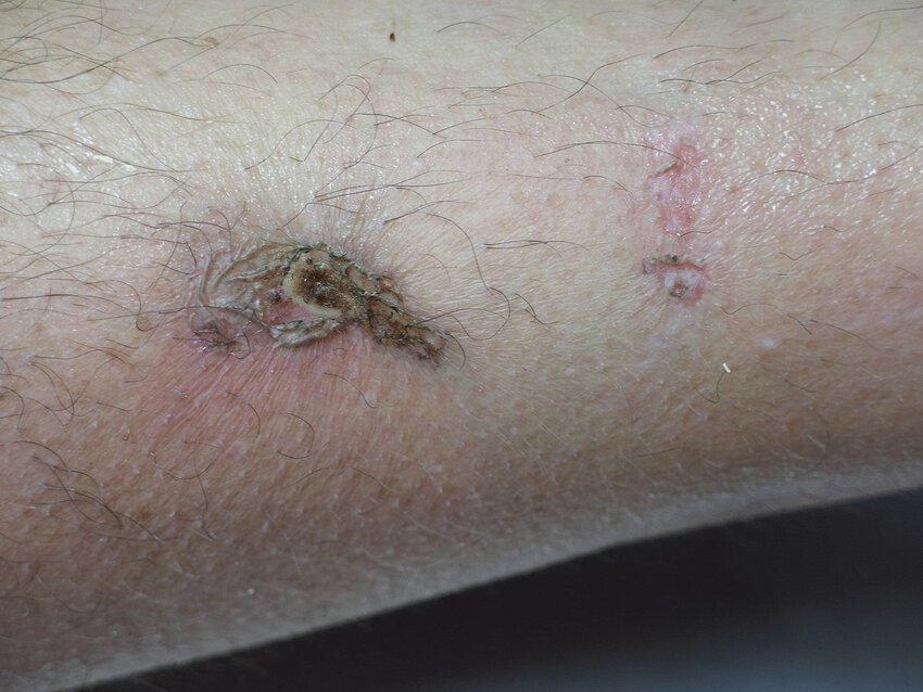 targetoid-electrical-burn-with-central-charring